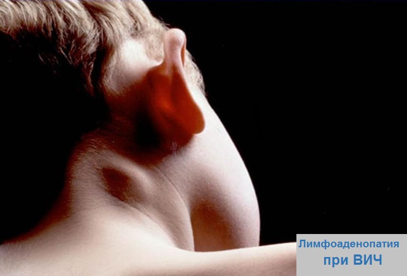 Лимфоузлы при ВИЧ Лимфоузлы при ВИЧ